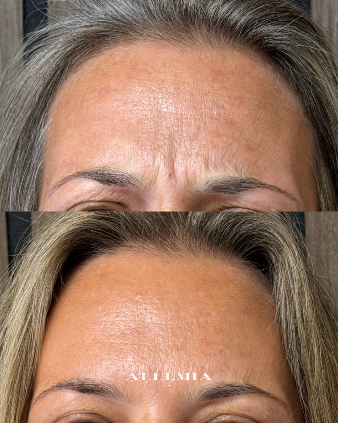 Anti-wrinkle injections