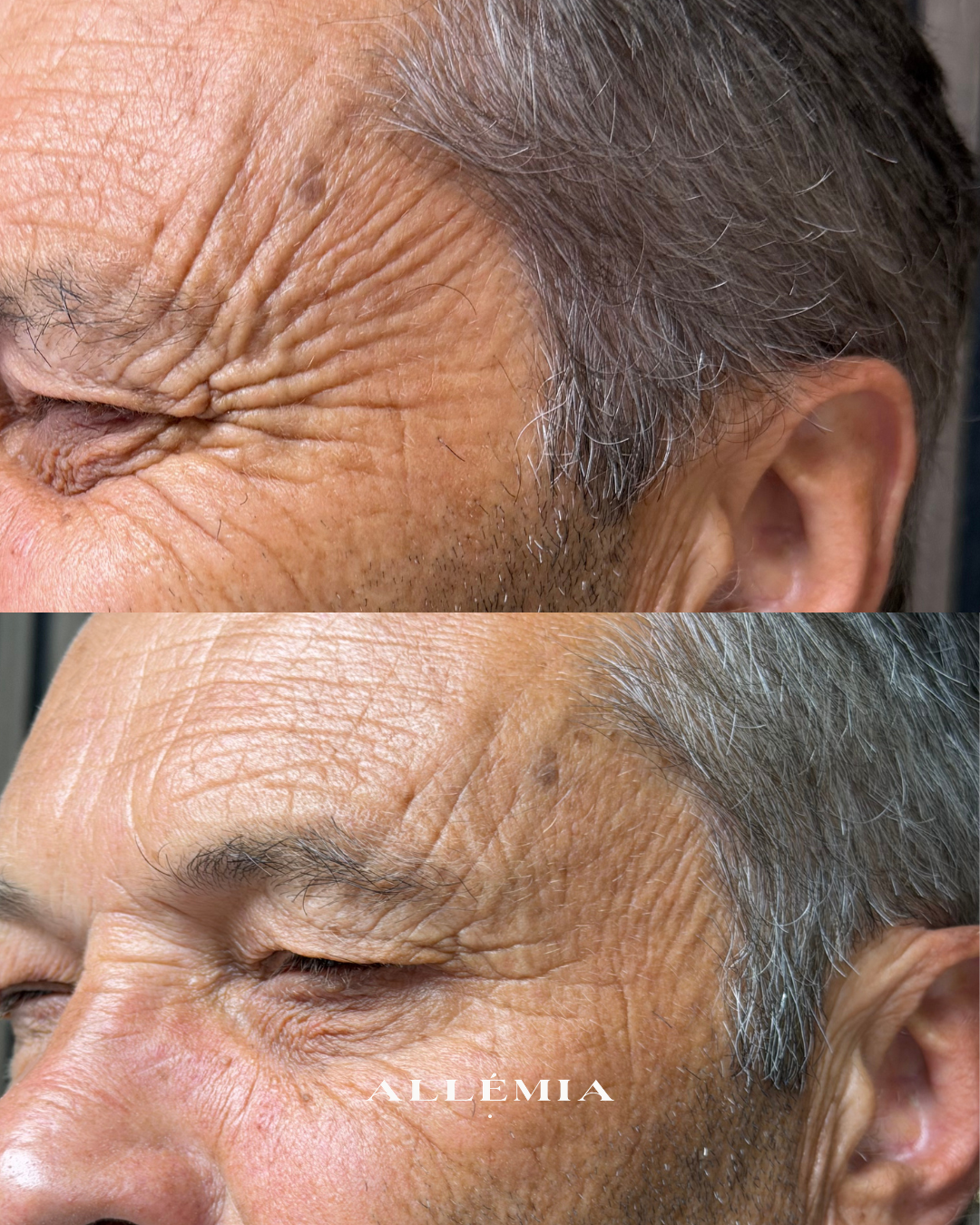 Anti-wrinkle injections