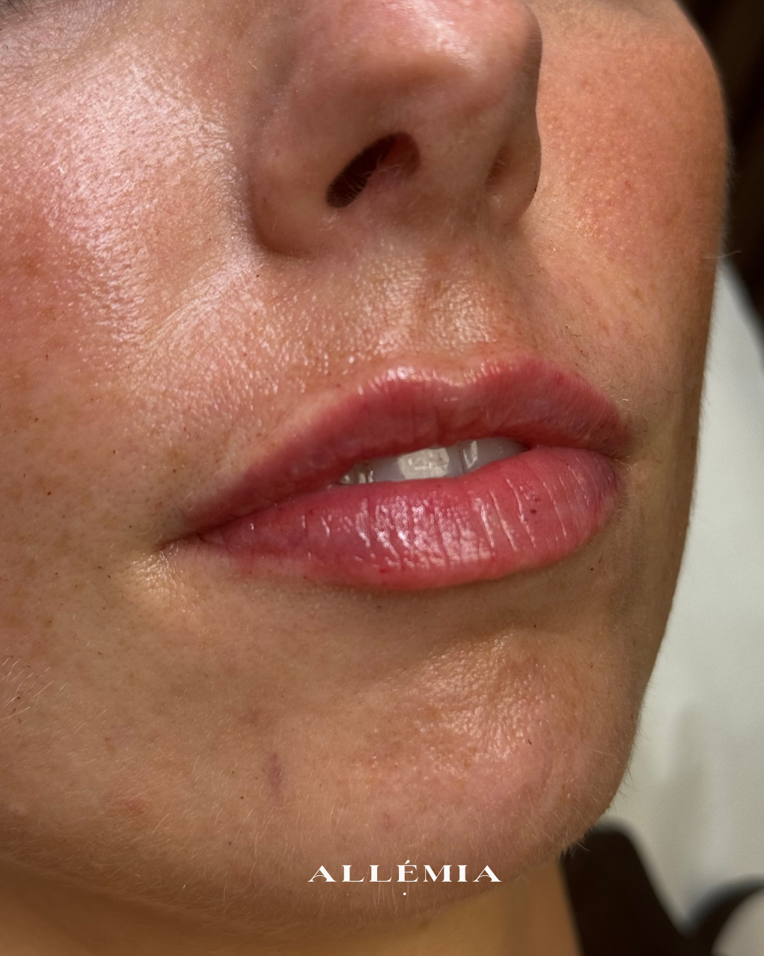 Lip filler