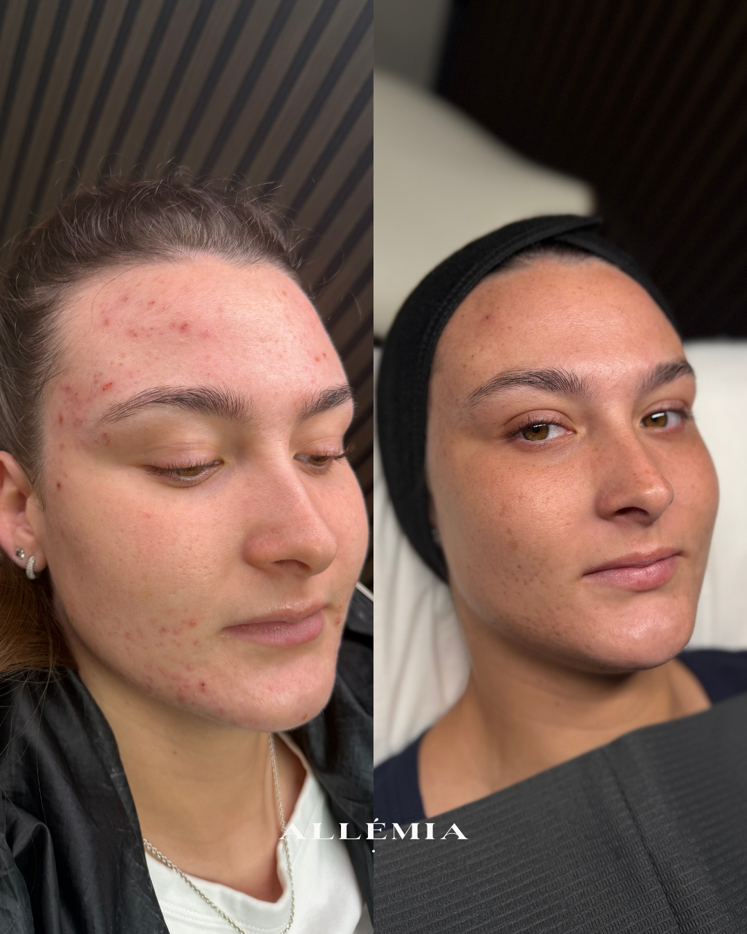 Skin transformation