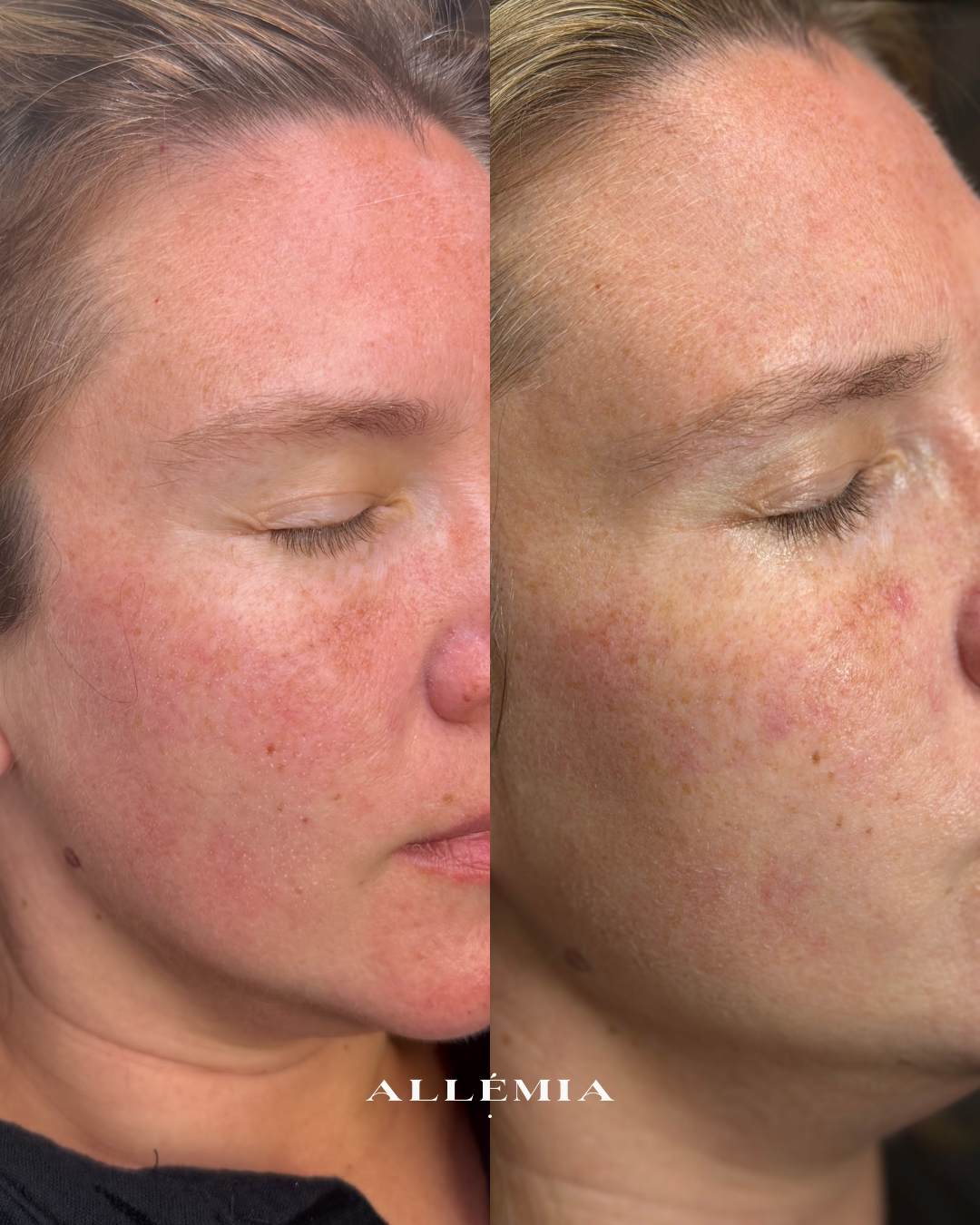 Close-up of a woman's face showing a before-and-after comparison of skin with improved texture and reduced redness.