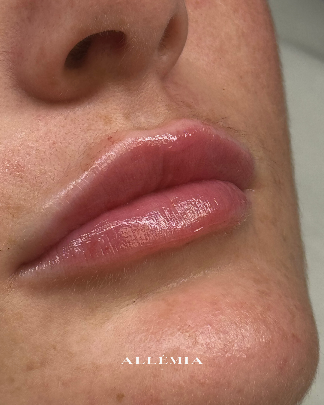 Lip filler