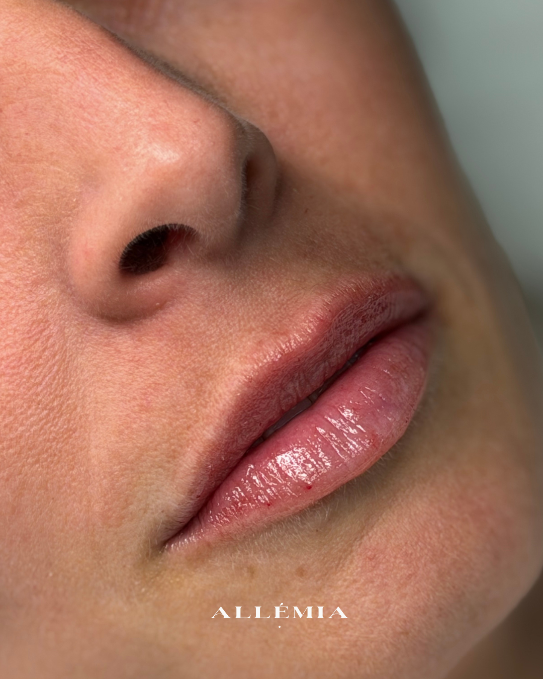Lip filler