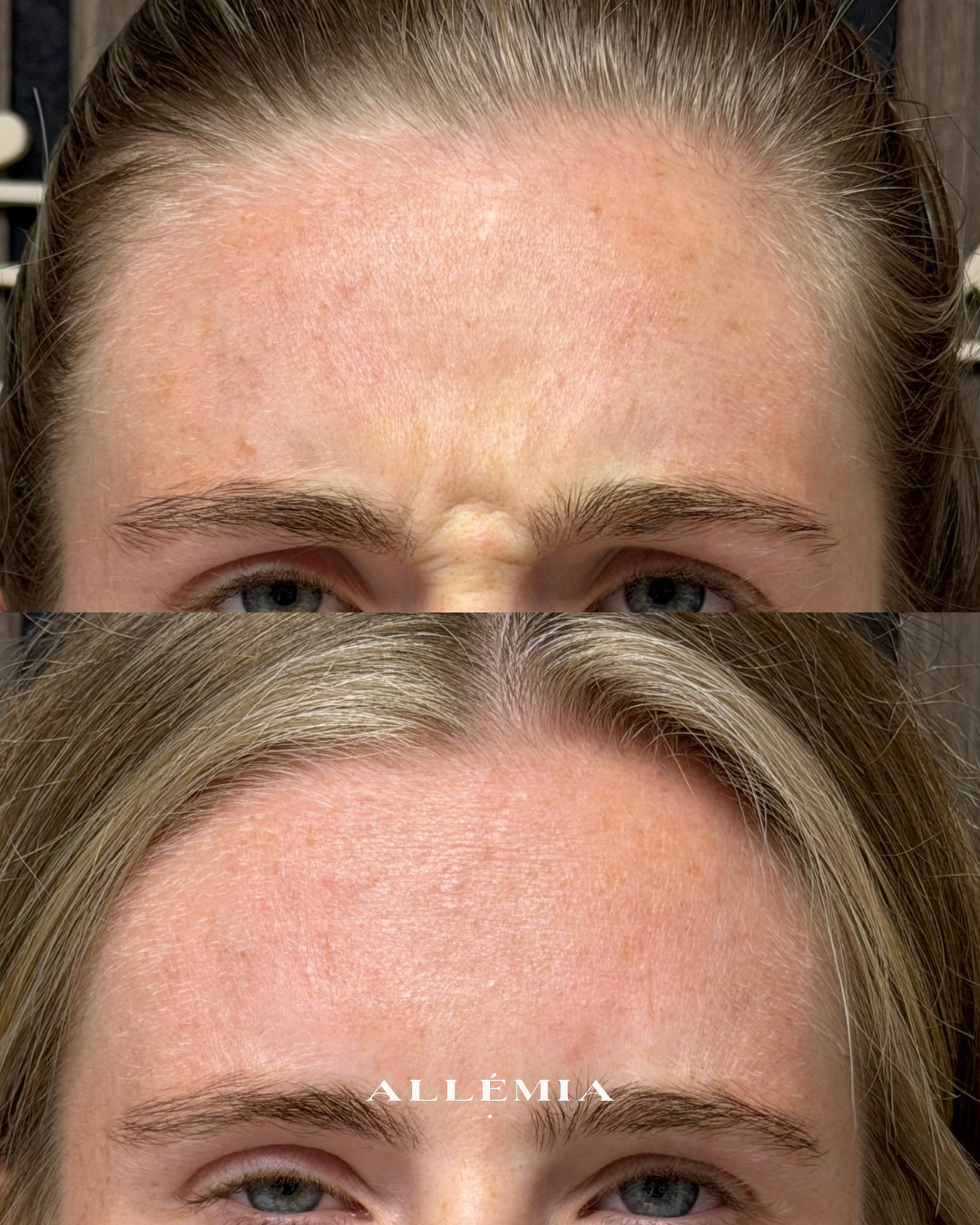 Anti-wrinkle injections