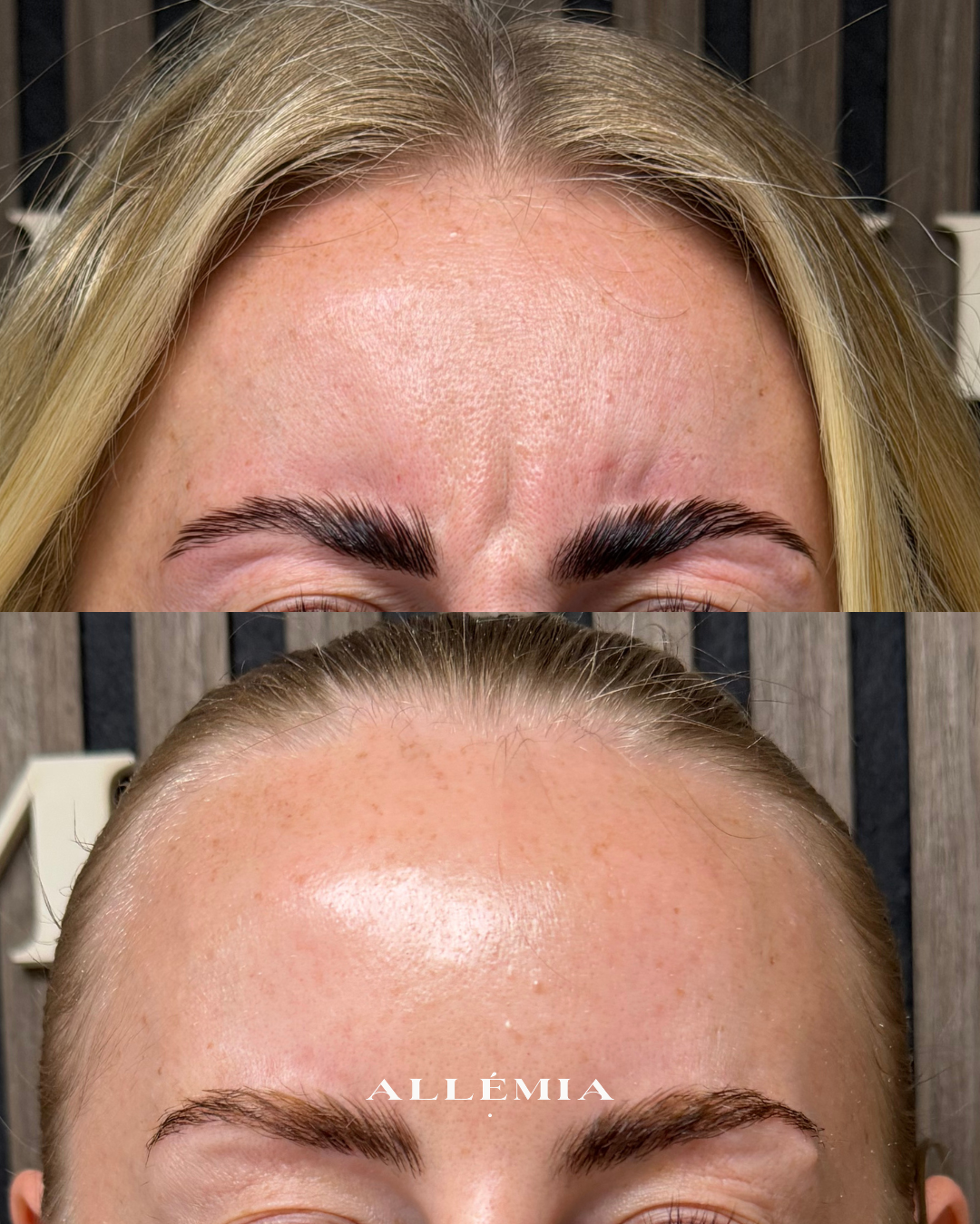 Anti-wrinkle injections