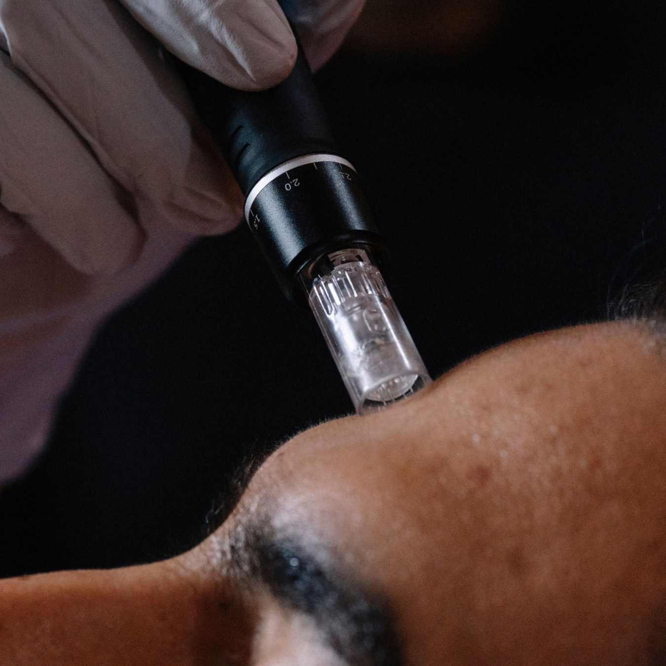 Professional microneedling treatment being performed on a client's forehead using a microneedling pen.