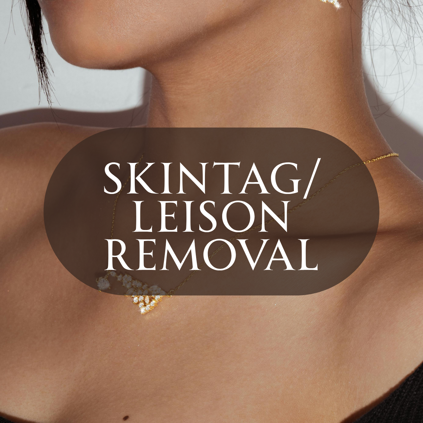 Close-up of a woman's neck and shoulder, representing mole and skin tag removal