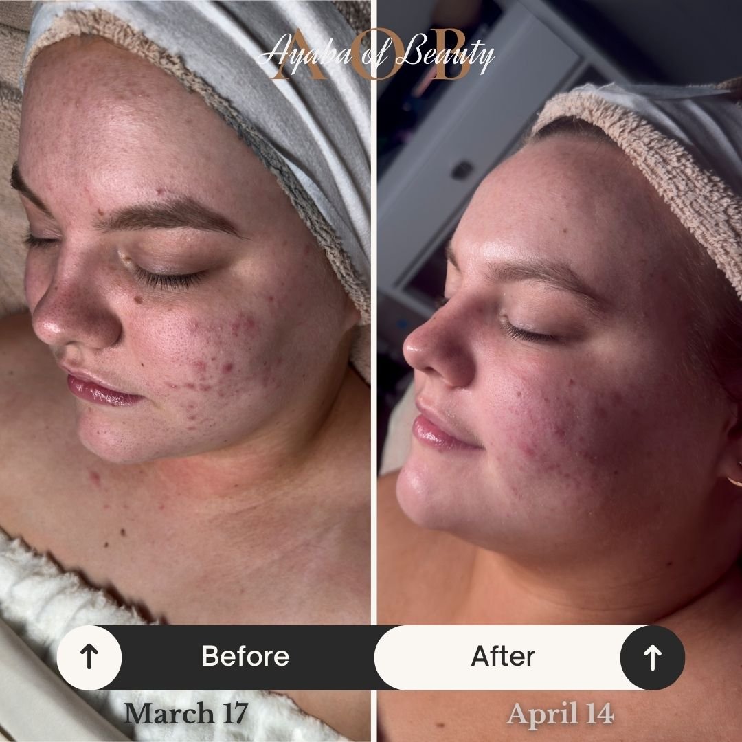 A months difference in a facial and consistent home-care routine