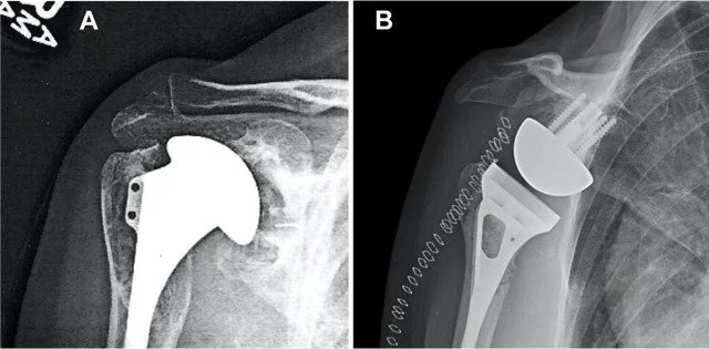 Radiographs of competing anatomic and reverse shoulder replacement systems