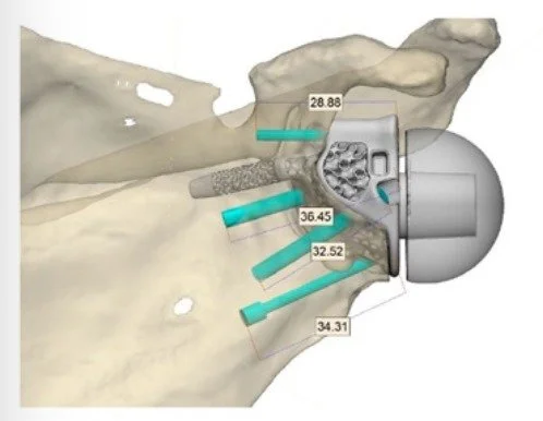 Competing shoulder implant design showing multiple screw trajectories through the scapula