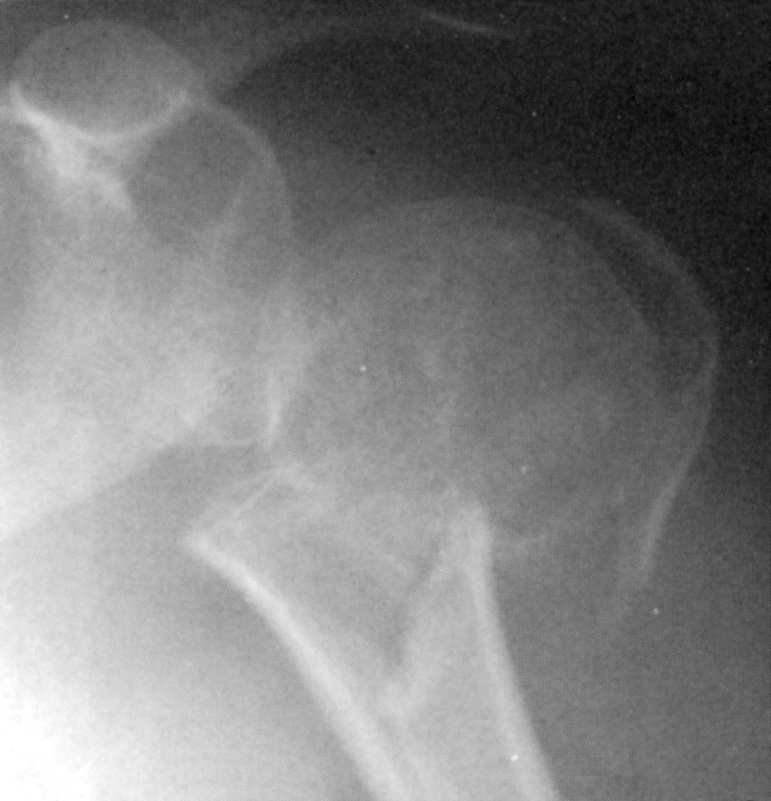 Historical proximal humerus fracture radiograph