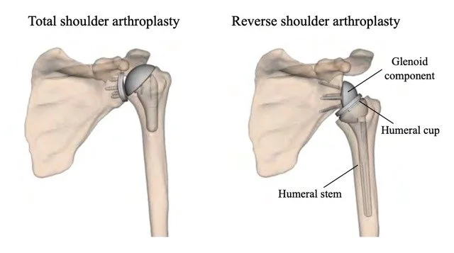 Why rethink shoulder replacement?