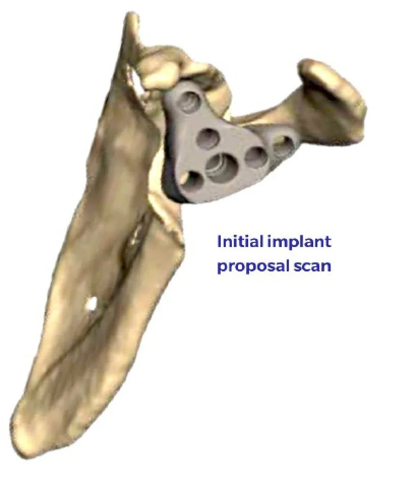 Competing patient-matched glenoid implant fitted to a scapula, with multiple fixation openings