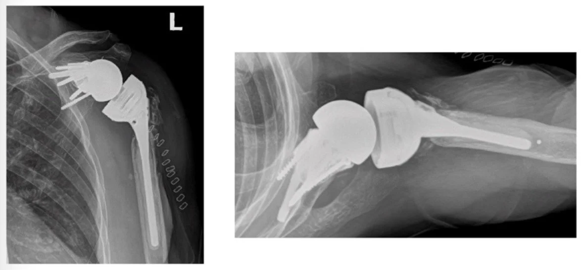 Two radiographic views of a competing shoulder replacement and its fixation
