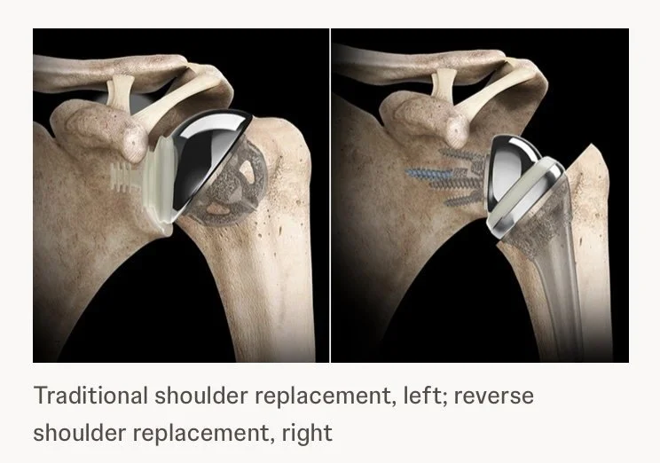 Models of current traditional and reverse shoulder replacement designs