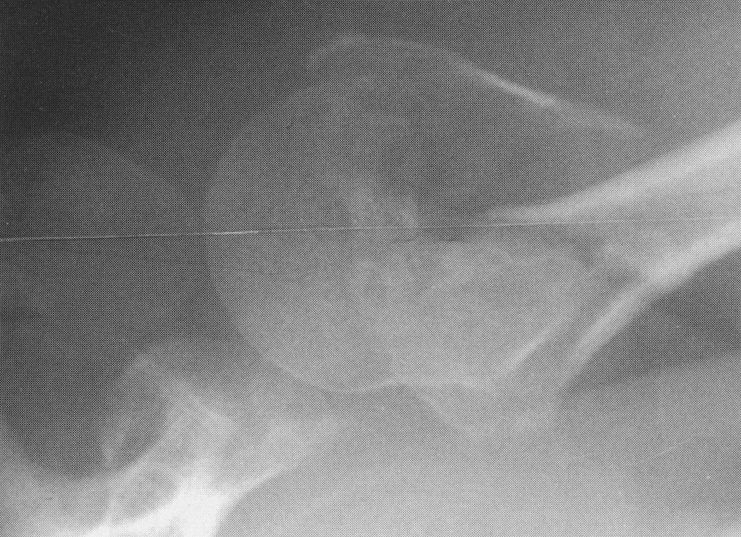 Additional proximal humerus fracture radiograph