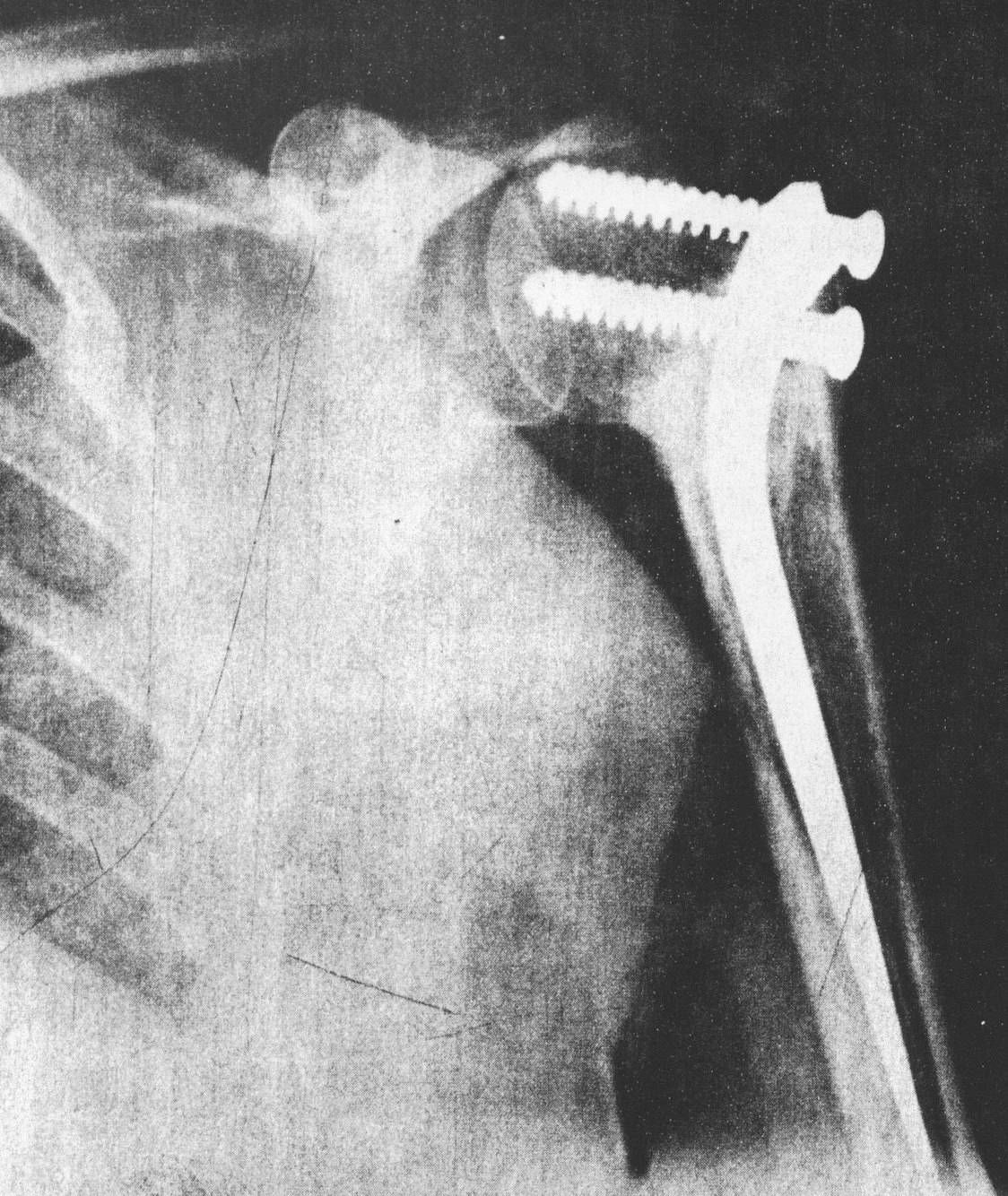 Radiograph showing surgical fixation of a proximal humerus fracture