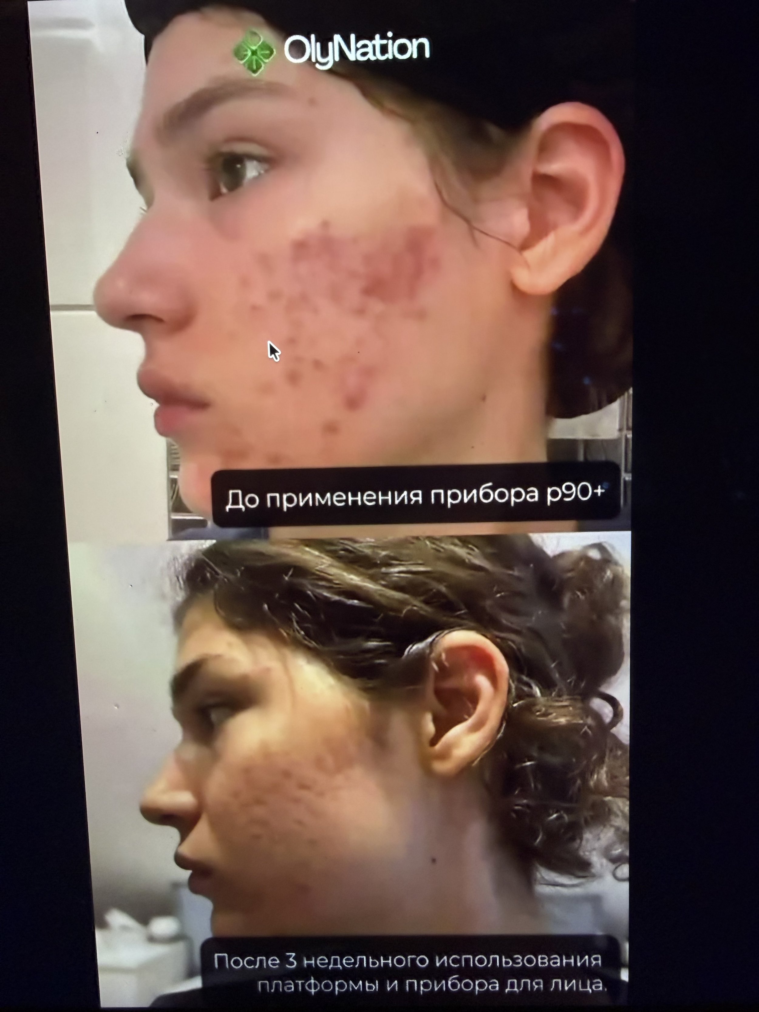 Close-up of a woman's face with acne scars and with them almost gone.