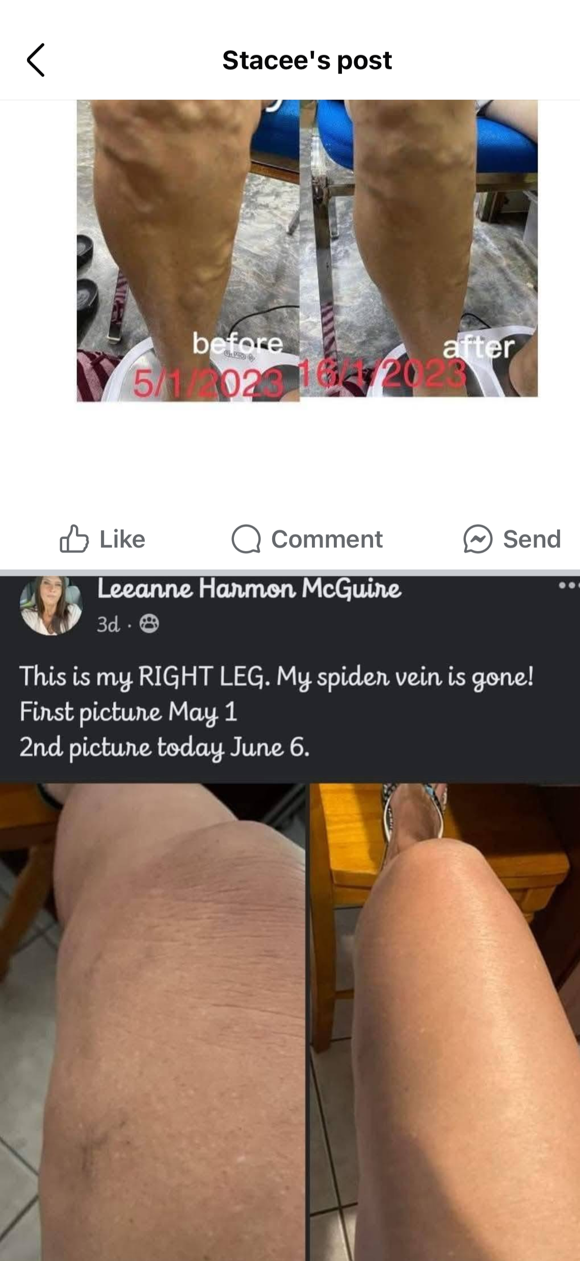 Comparison of a person's right leg before and after spider vein treatment, with noticeable reduction in visible veins.