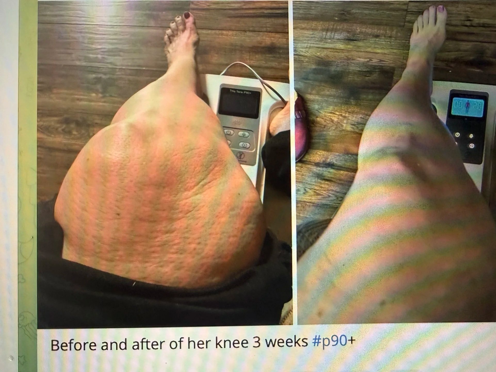 Side-by-side comparison of a person's knee before and after three weeks of treatment. The left side shows the knee with visible scars, bruising, and swelling. The right side shows the knee with reduced scars, bruising, and swelling. 