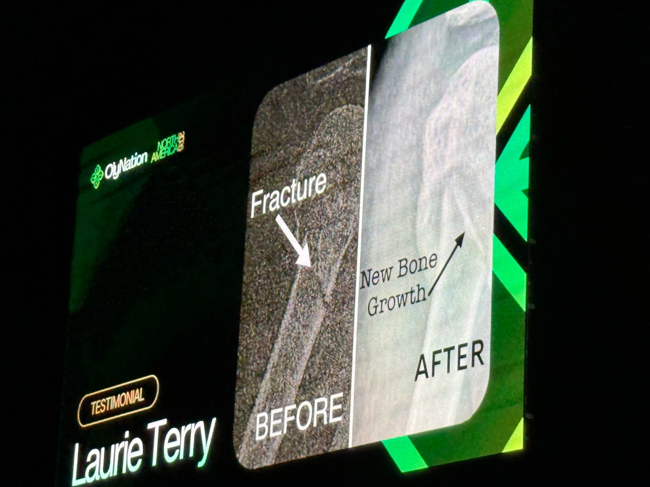 Close-up of an informational display about bone fractures, showing images of fractured and healed bones before and after.