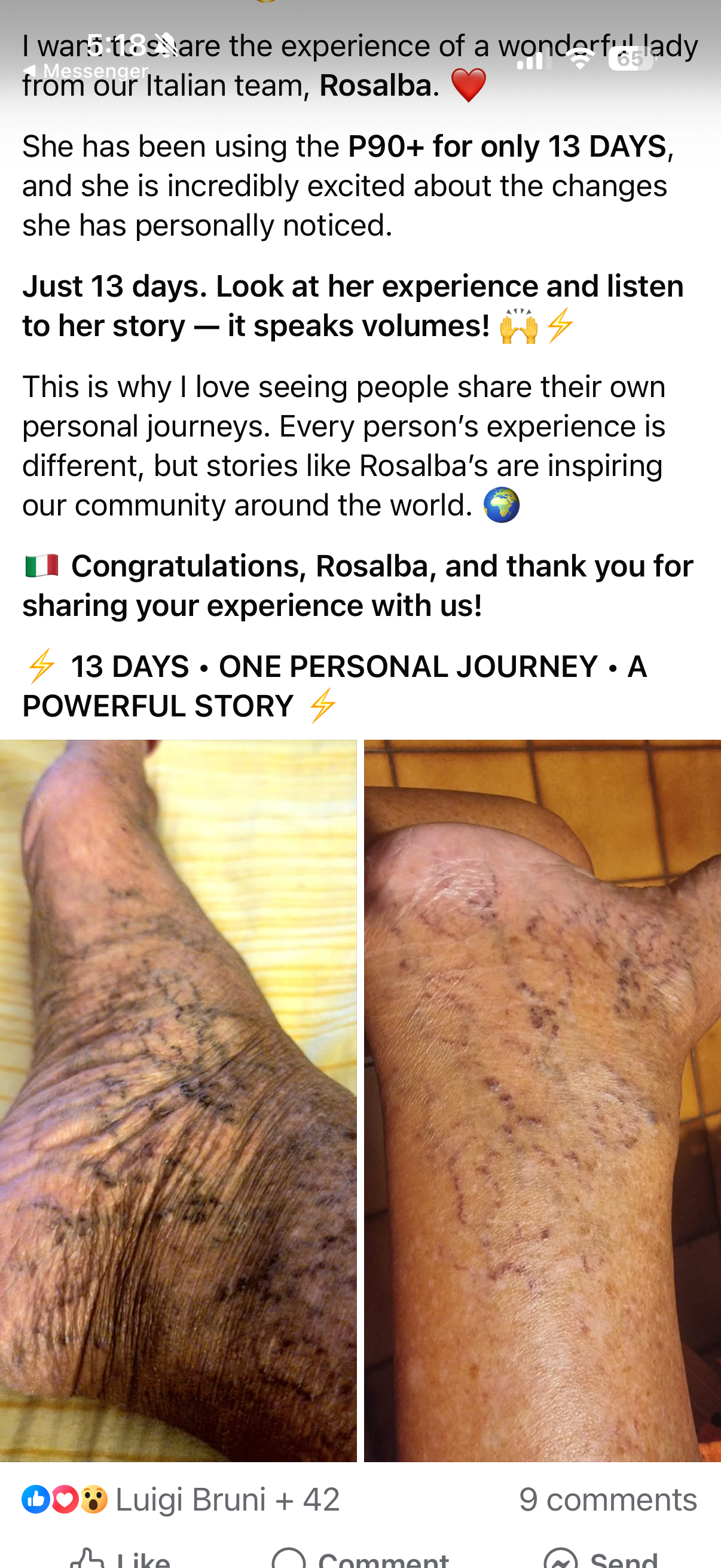 Comparison of a leg before and after treatment showing significant improvement in skin condition and reduced scarring.