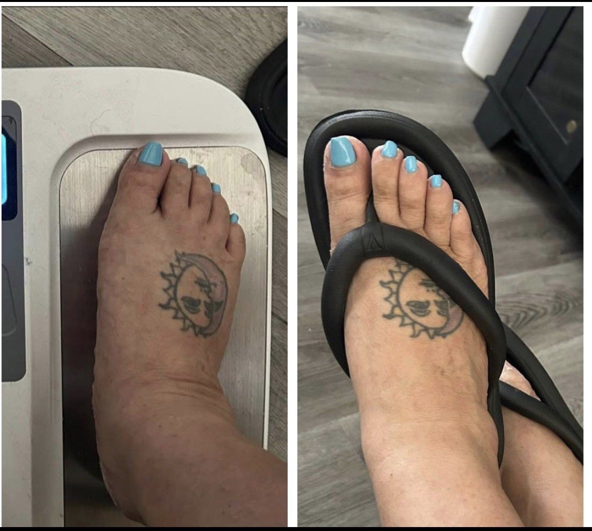 Before and after pictures of a swollen foot.