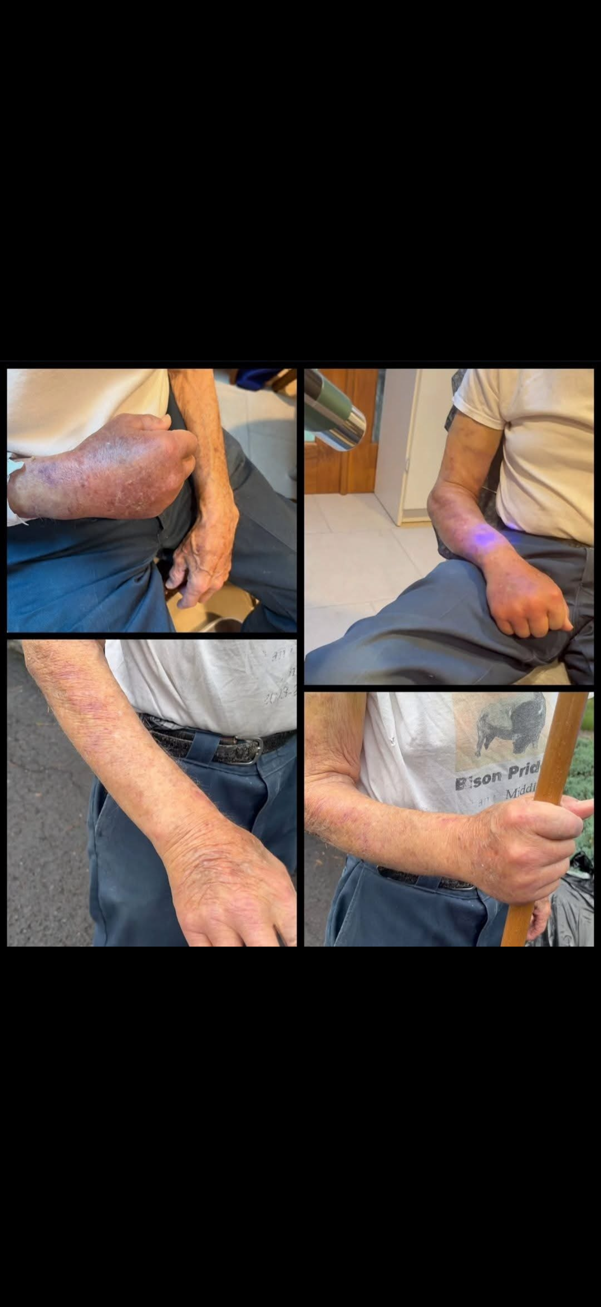 Elderly man's arms showing skin conditions, including discoloration, freckles, and some bruising and pictures of clearer skin.