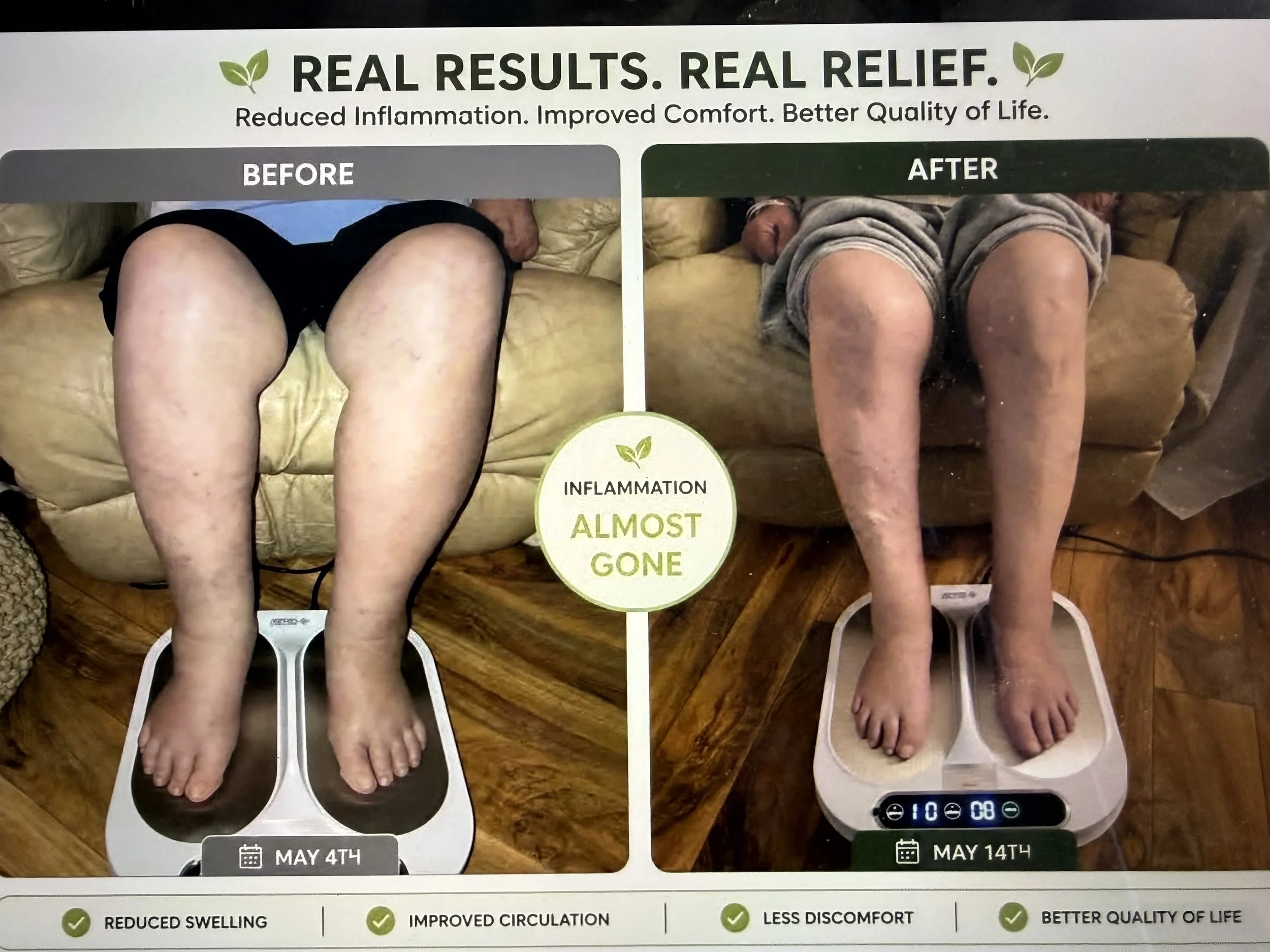 Comparison of legs before and after treatment showing reduced swelling and improved circulation.