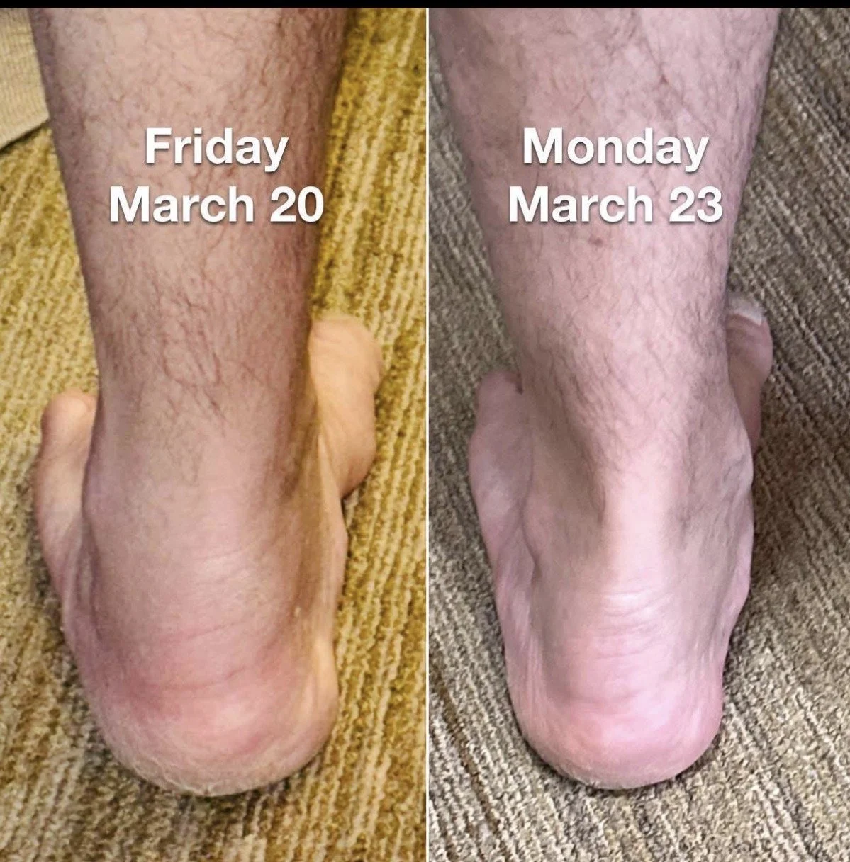 Comparison of a person's foot and ankle on March 20 and March 23 showing reduction in swelling and skin texture changes over three days.