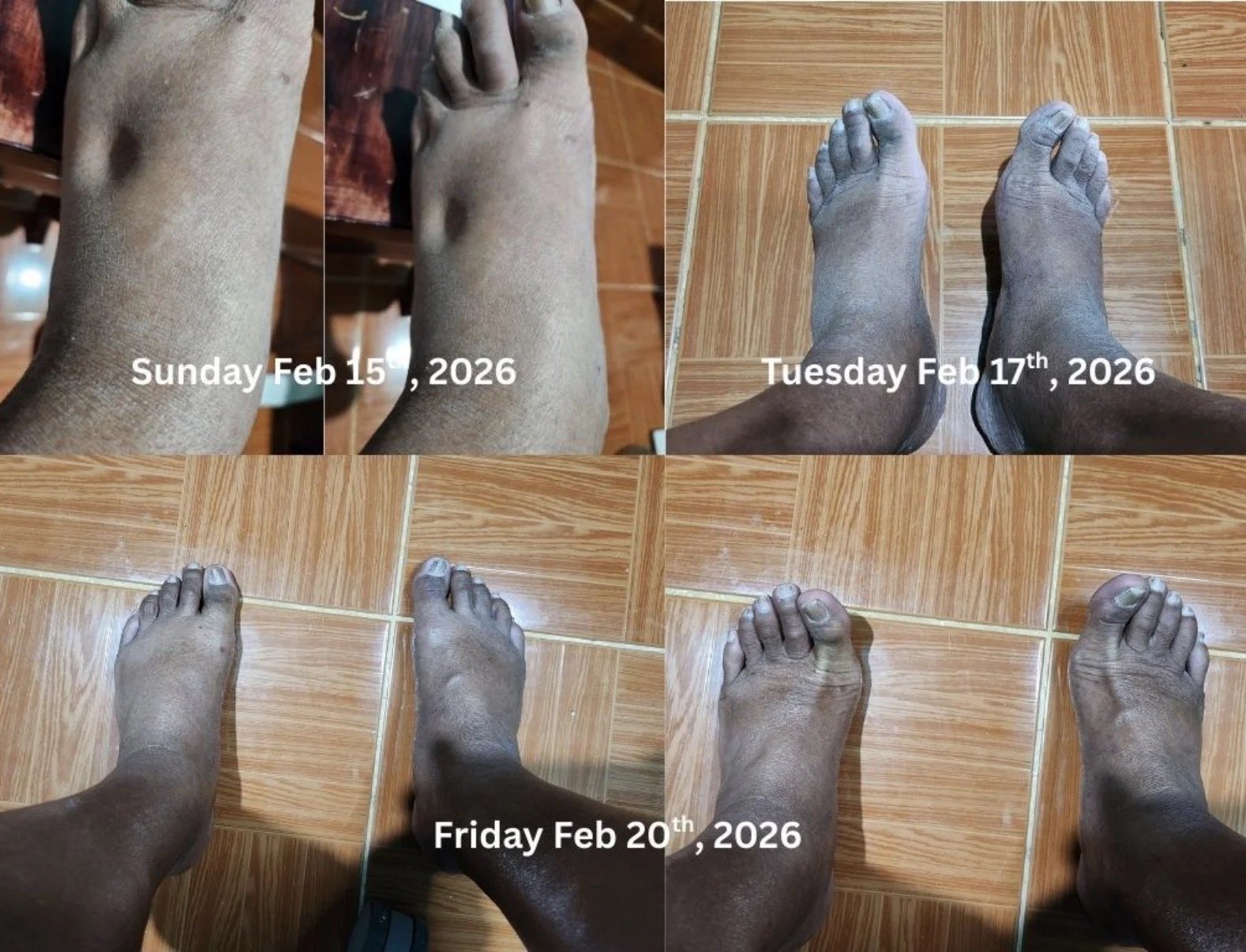 A collage showing the progression of a person's feet over three days, from February 15 to February 20, 2026. The first image depicts dry, rough skin. The second image shows slightly improved skin condition. The third image indicates further improveme