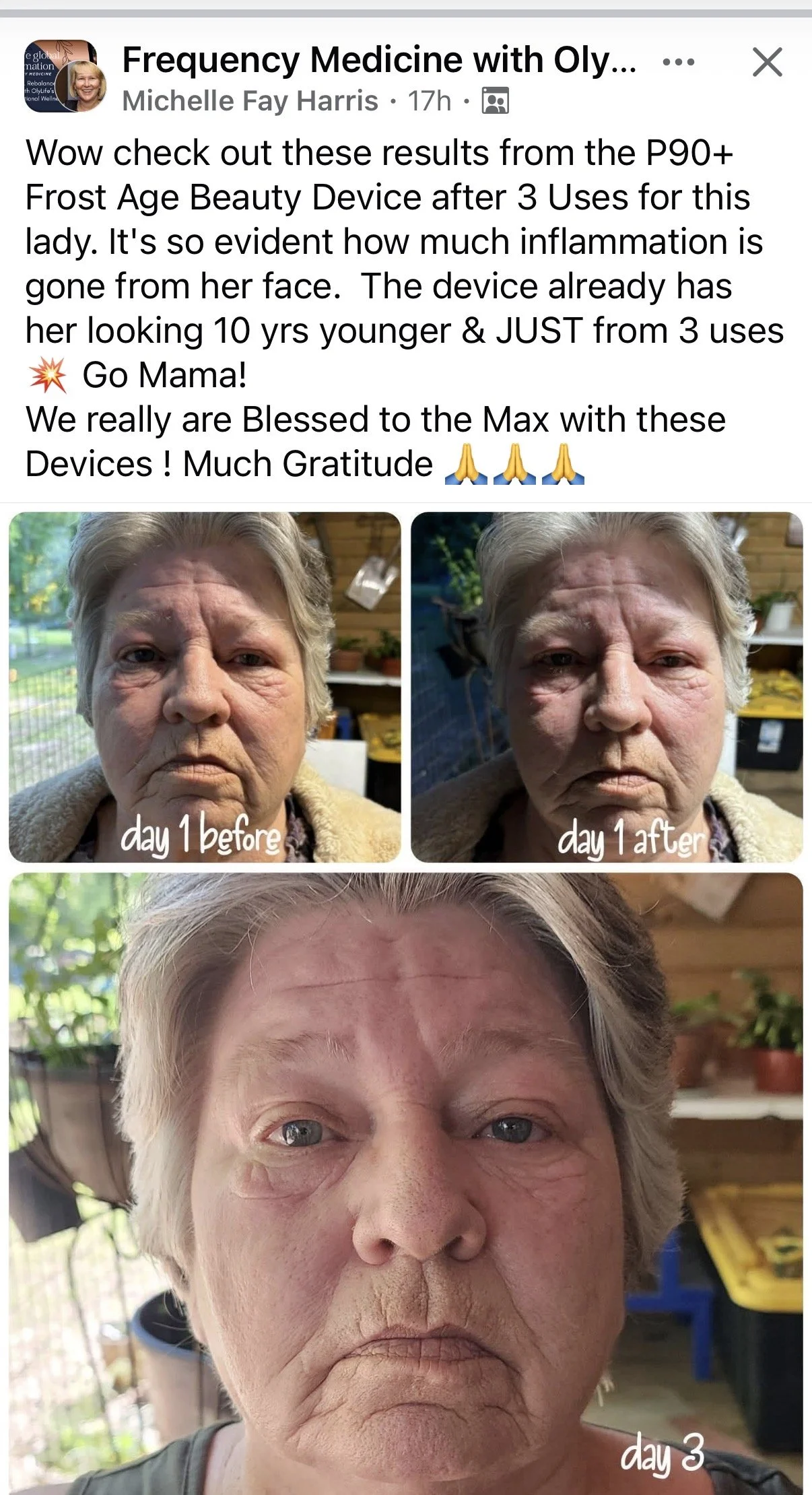 Progress photos of an elderly woman showing skin improvement over three days. Day 1 before, day 1 after, and day 3.