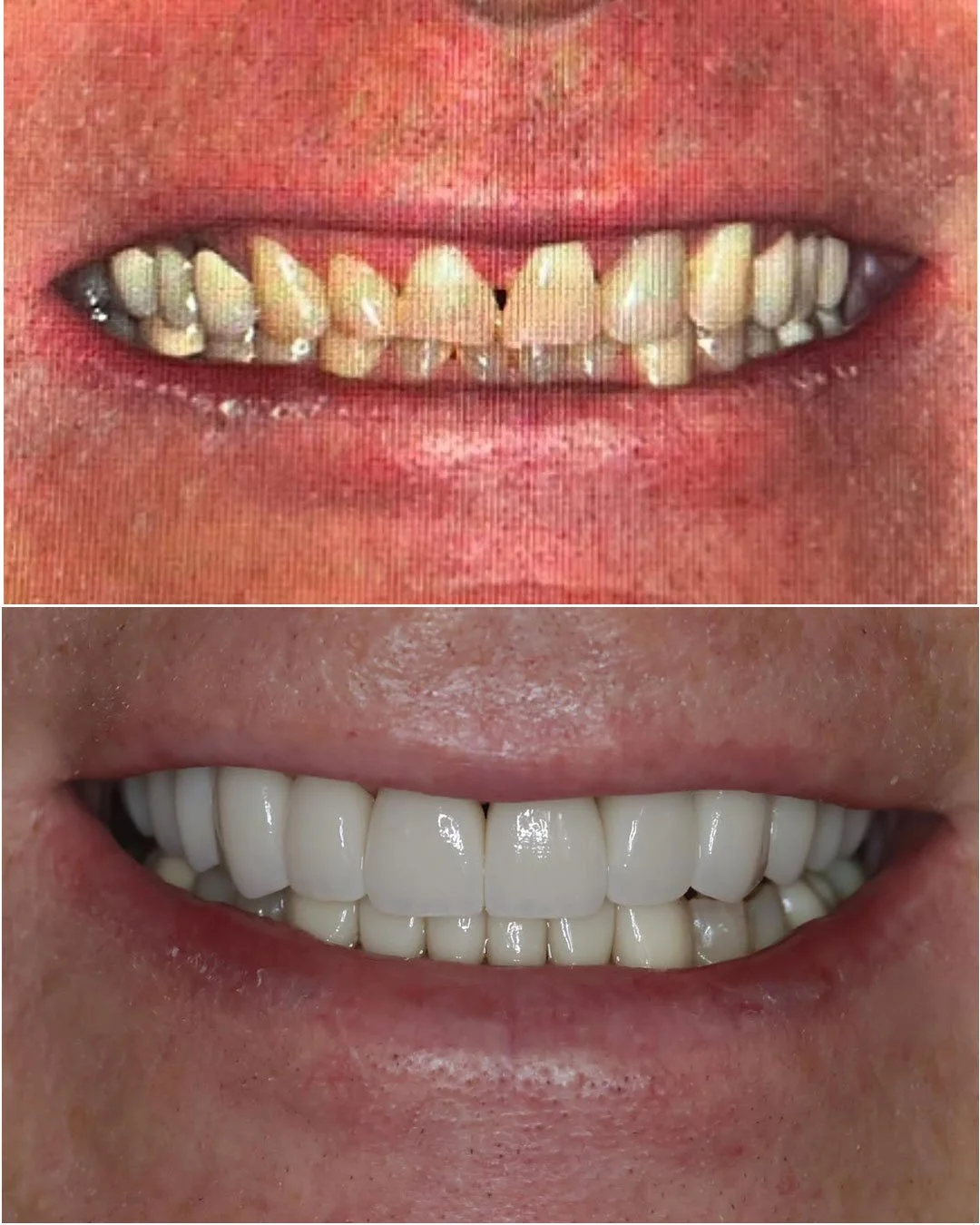 Full Mouth Rehabilitation