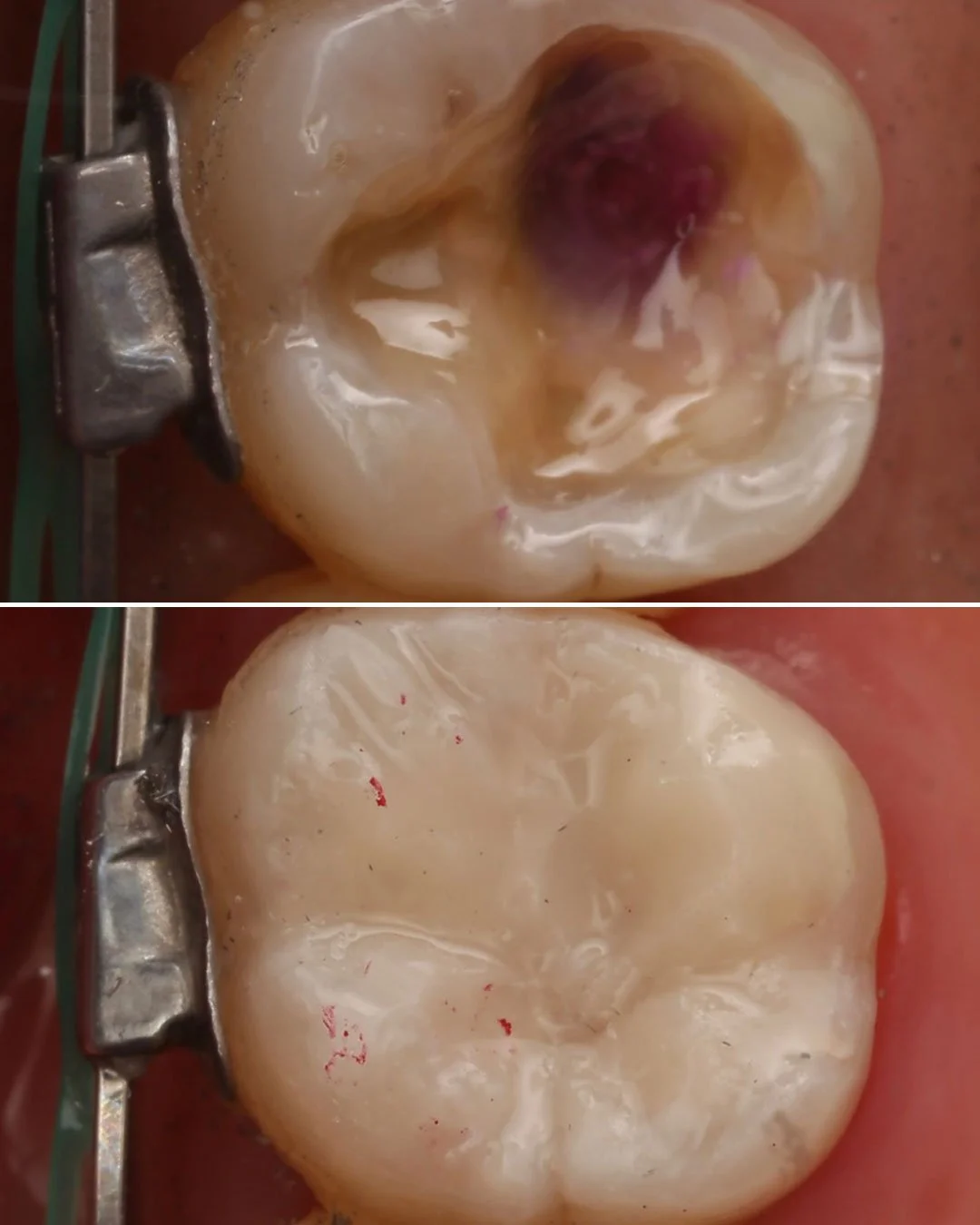 Deep Cavity Restoration