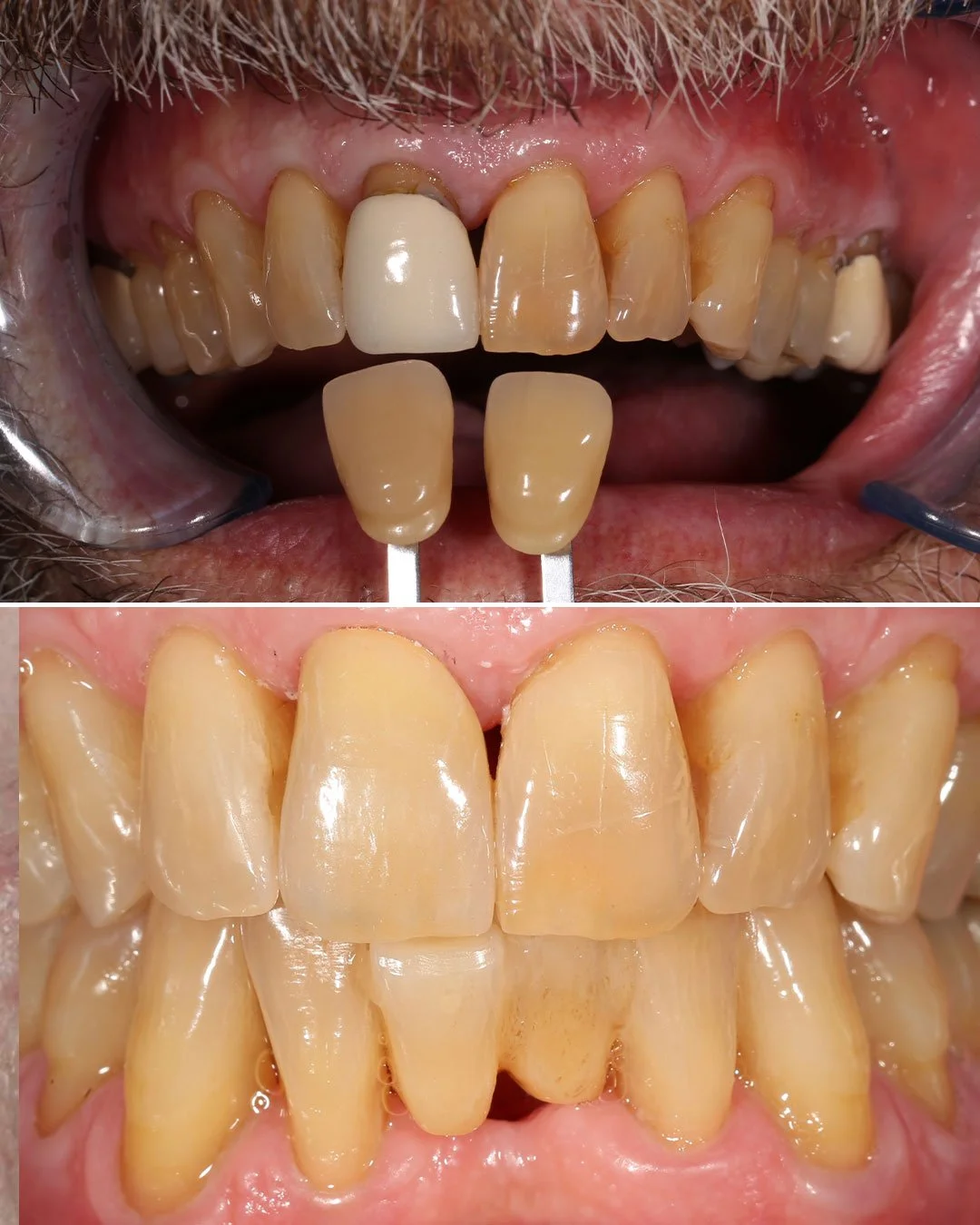 Crown Replacement