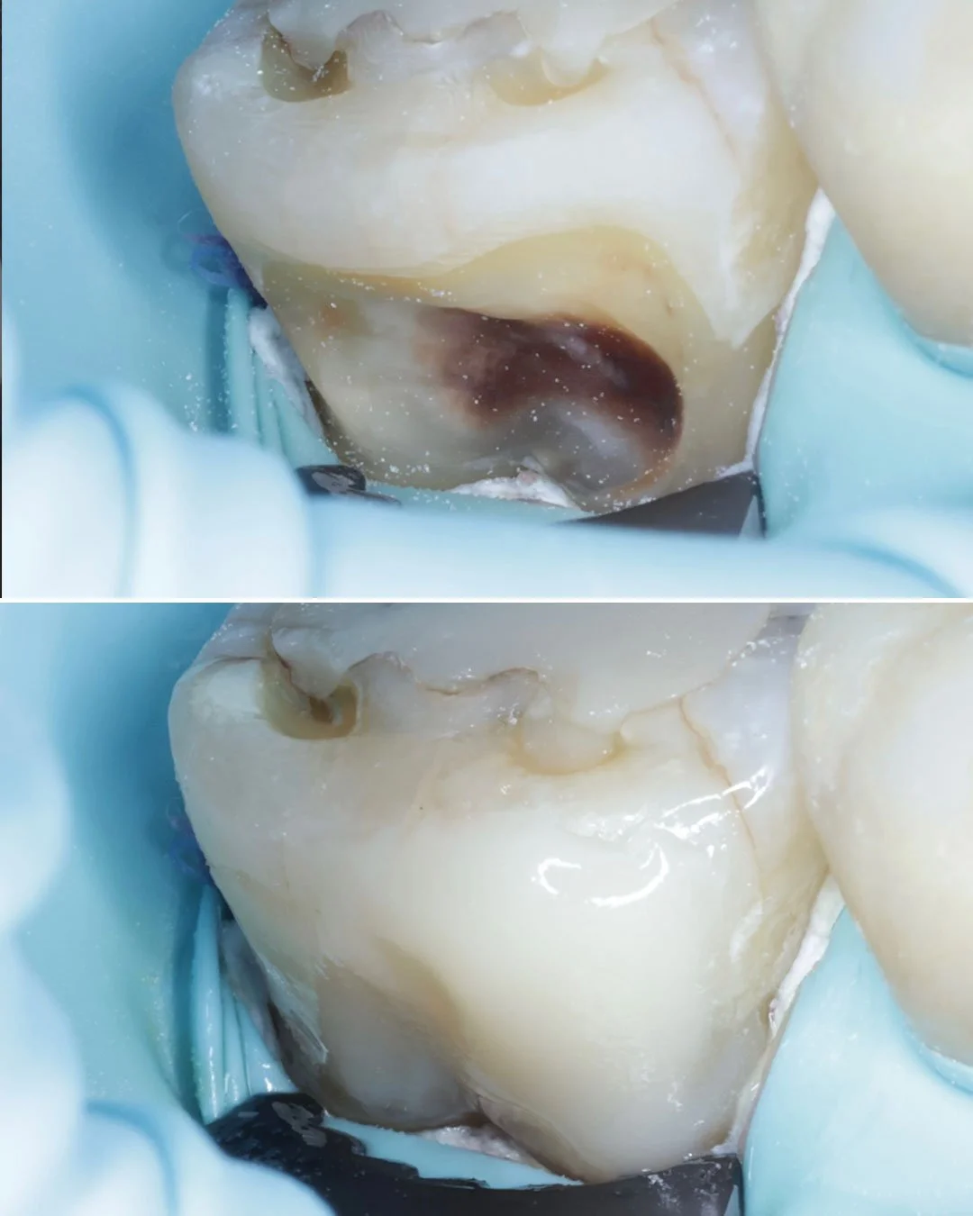 Gumline Cavity Restoration