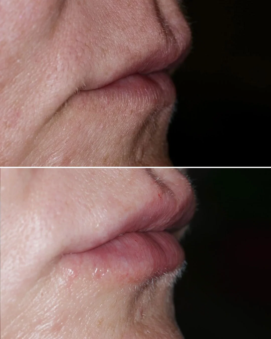 Lip Enhancement