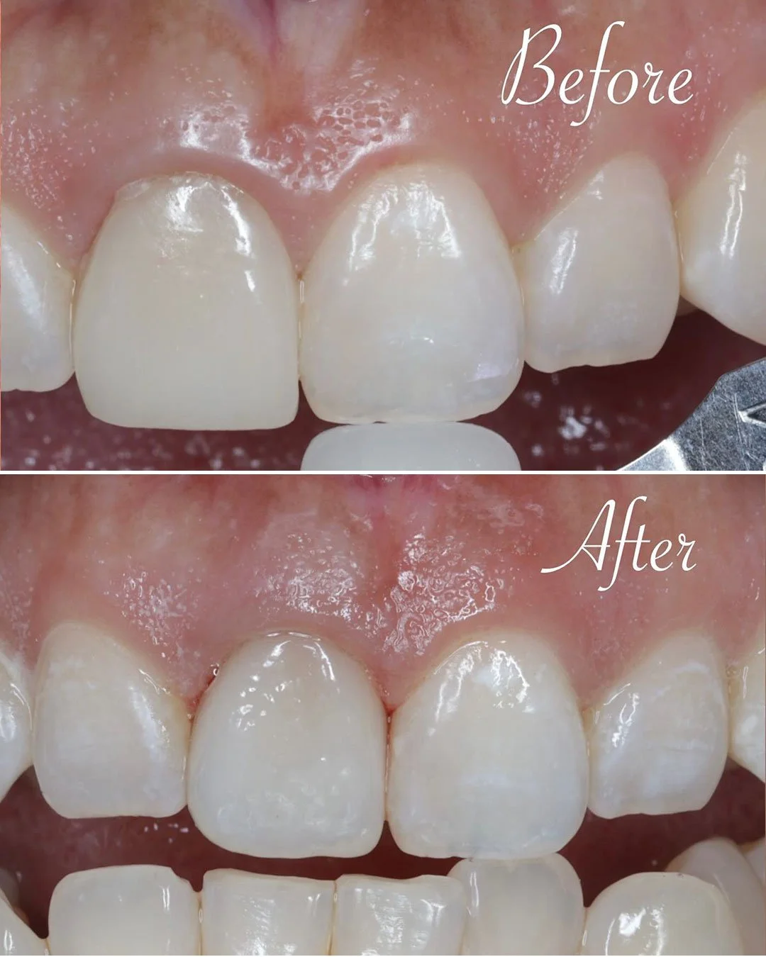 Front Tooth Crown