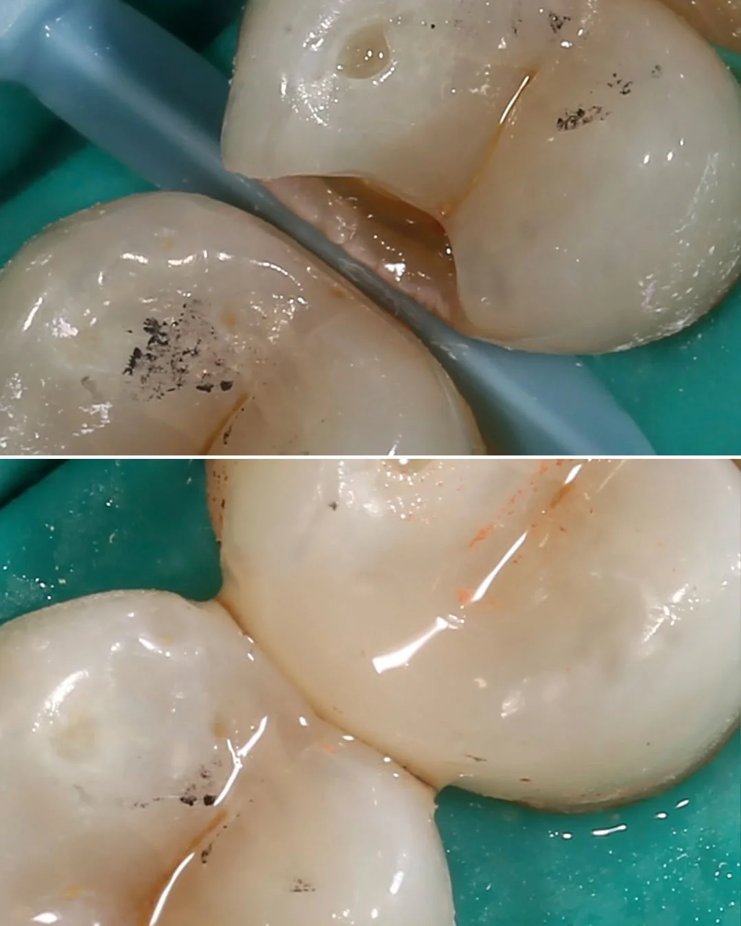 Cavity Filling