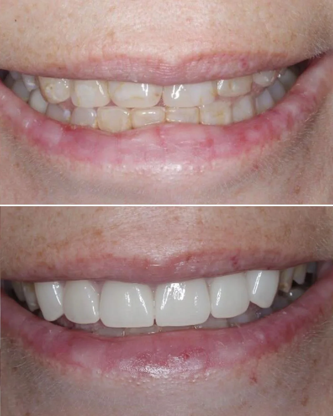 Smile Makeover