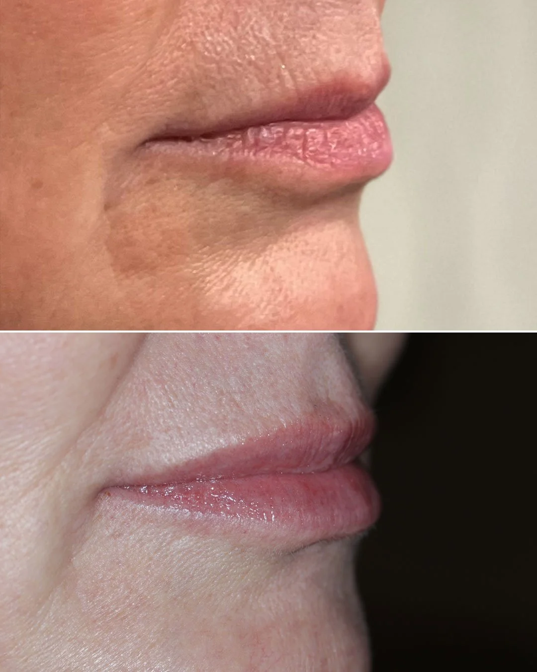 Lip Enhancement