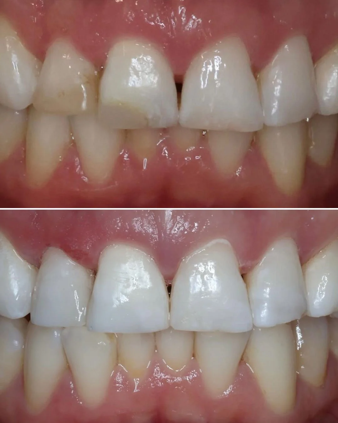 At-home teeth whitening treatment