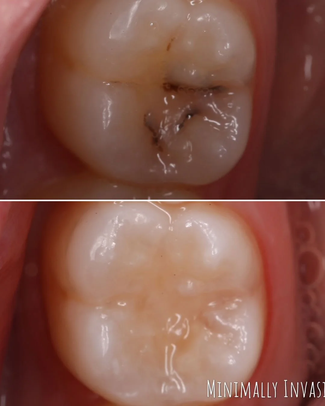 
Minimally Invasive Cavity Restoration