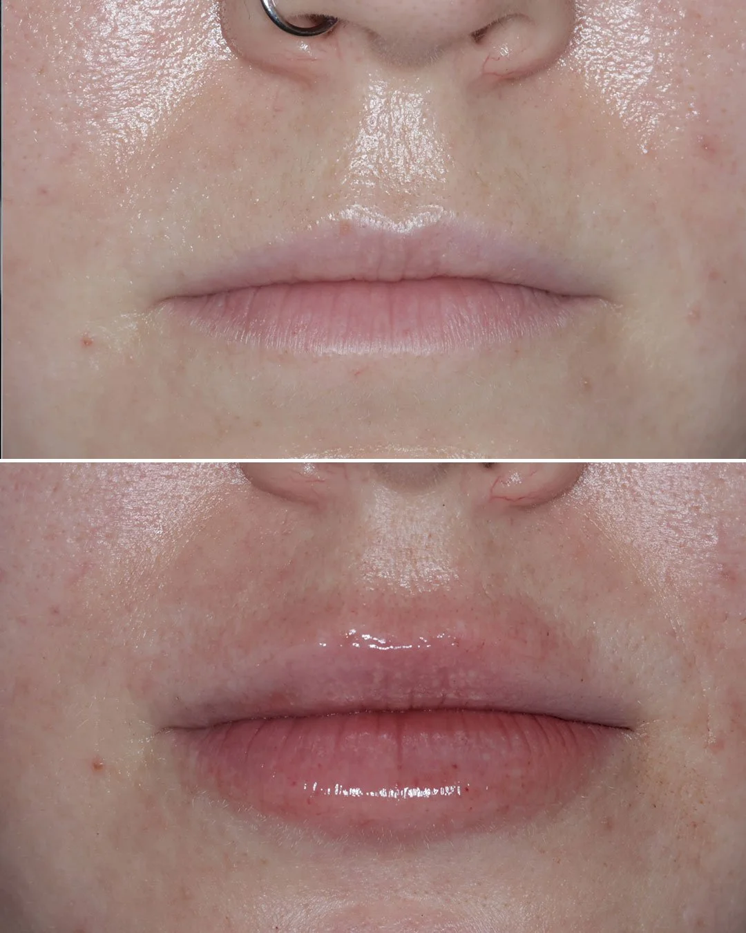 Lip Enhancement