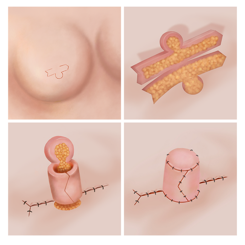 Custom medical illustration