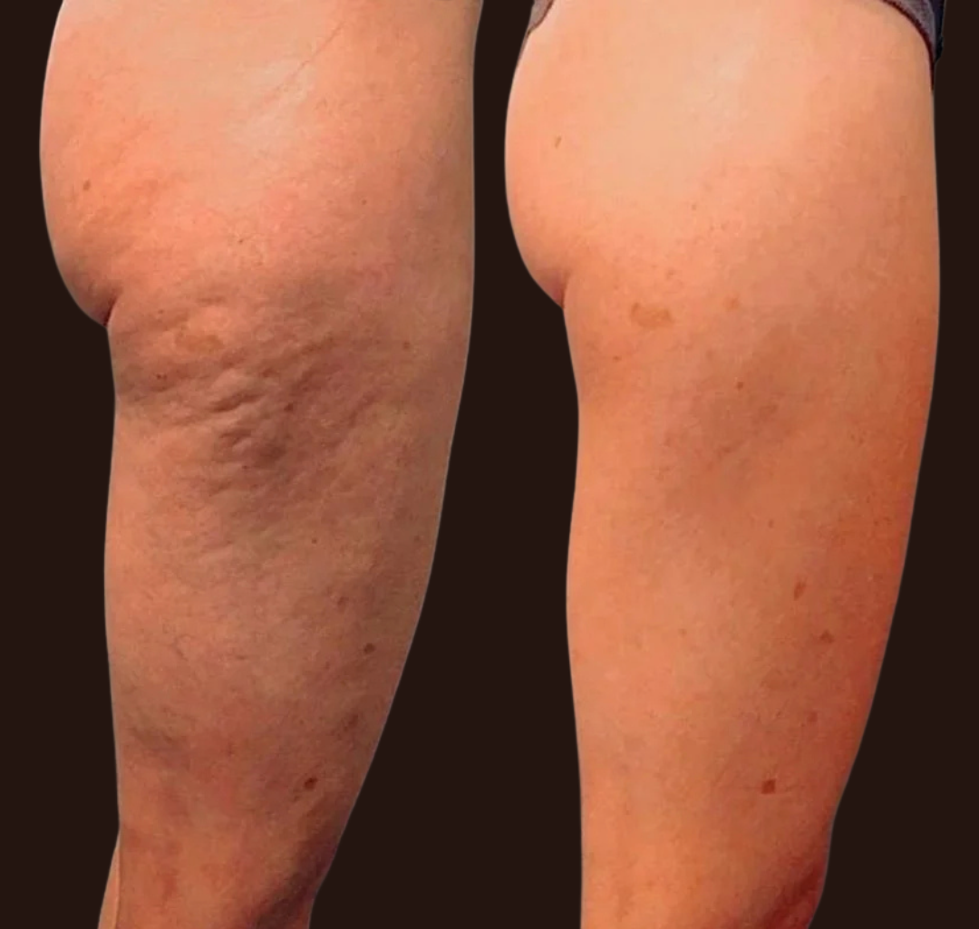 Cellulite Reduction Treatment at Rejuvenate Wellness in Florence, KY