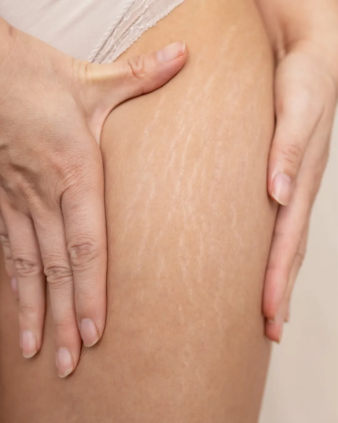 Stretch Mark Removal in Florence, KY at Rejuvenate Wellness