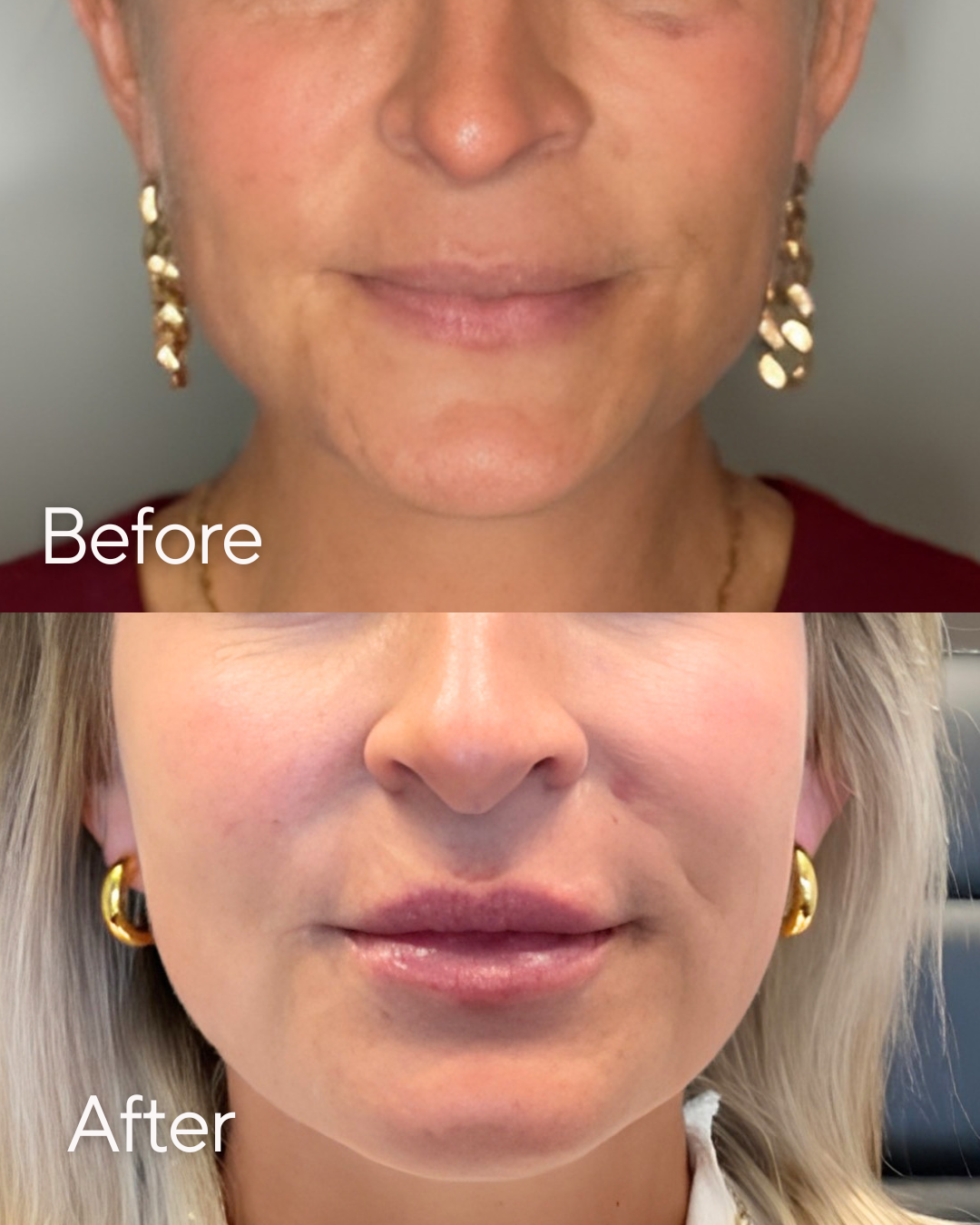 Before and after images of a woman's face showing cosmetic or skincare results, focusing on the lower face and lips at Rejuvenate Wellness in Florence Kentucky