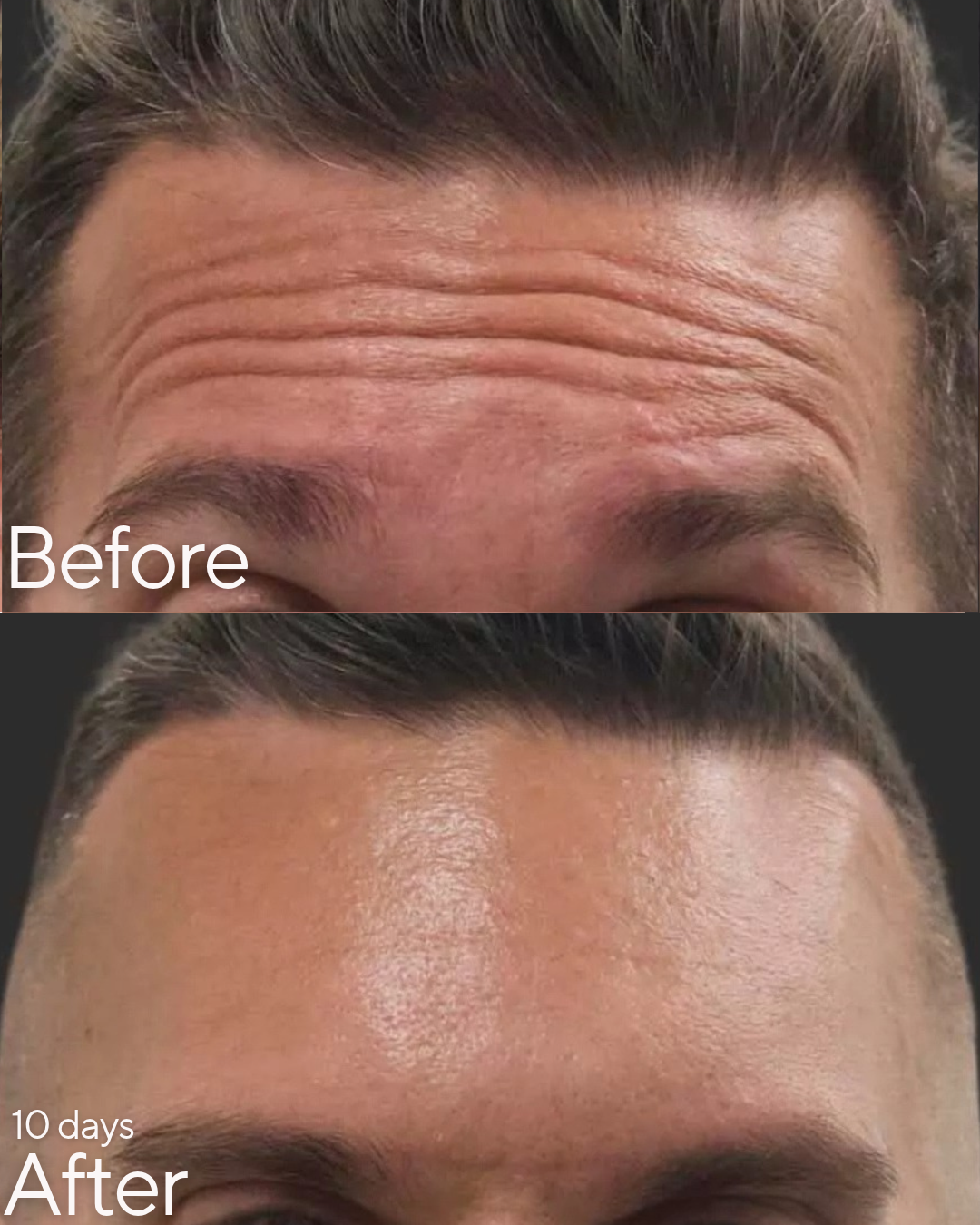 Botox at Rejuvenate Wellness in Florence, KY