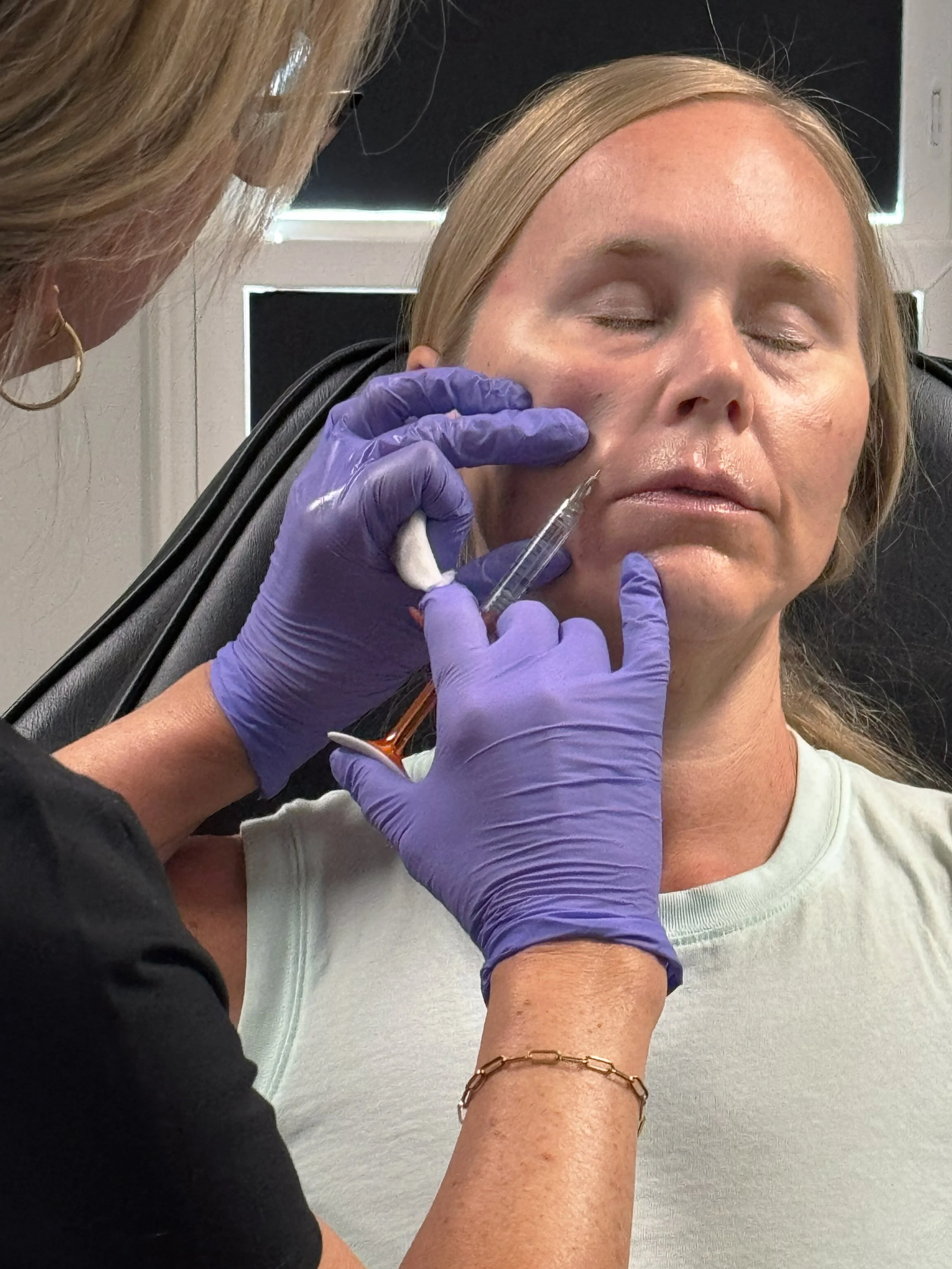 Injectable Filler Nasolabial Folds at Rejuvenate Wellness in Florence Kentucky